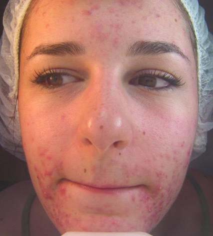 Orange County Chemical Peels Before and After Photos - Orange Plastic ...