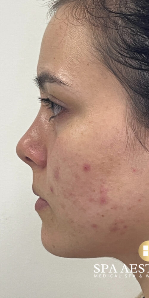 AviClear Acne Treatment