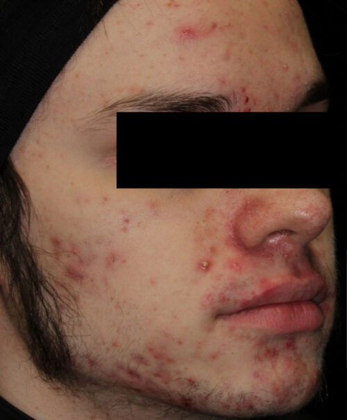 AviClear Acne Treatment