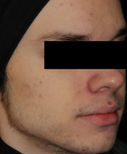 AviClear Acne Treatment